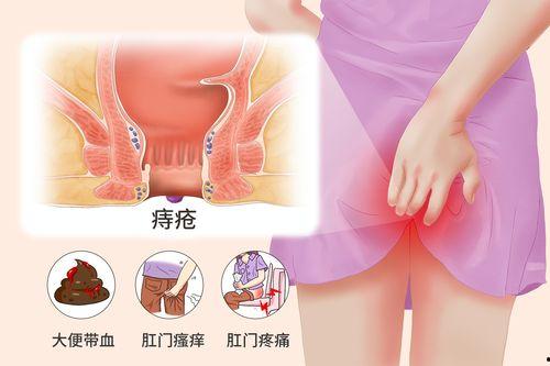 痔疮初期图片,早期症状与预防策略揭秘
