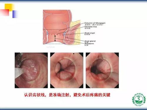 痔疮治疗视频,专业指导，轻松告别不适