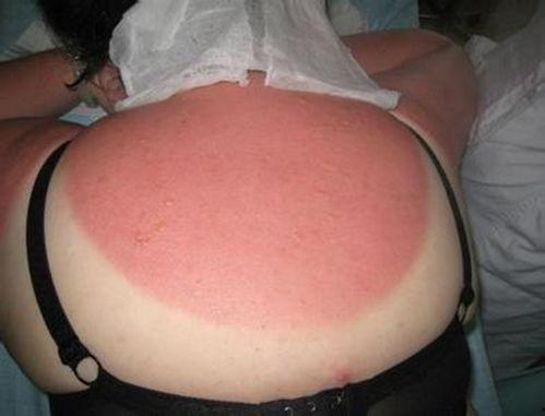 紫外线过敏图片,图片揭示肌肤敏感之谜