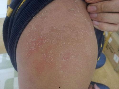 紫外线过敏图片,图片揭示肌肤敏感之谜