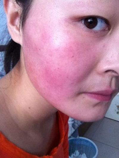 紫外线过敏图片,图片揭示肌肤敏感之谜