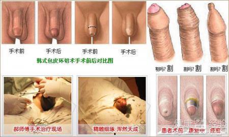 包皮切割视频,专业视角下的直观解读