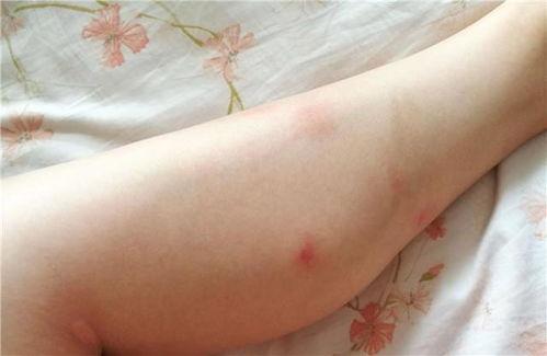 蚊子咬了图片,揭秘吸血鬼的“美食”之旅